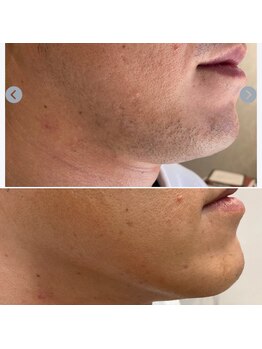 エピシアドットエヌ(epicia.N)/ヒゲ脱毛☆ほぼ生えない♪