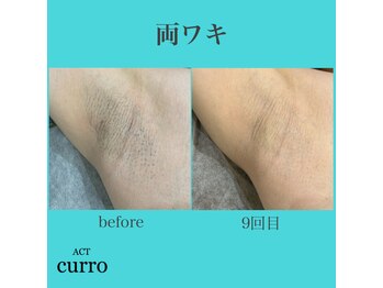 アクト クロ(ACT curro)/【両ワキ】脱毛施術例
