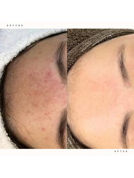 イチロクイチハチ(1618)/隠してるニキビもケアしませんか