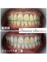 ホワイトニングサロン 京都烏丸店/ホワイトニング施術例　　