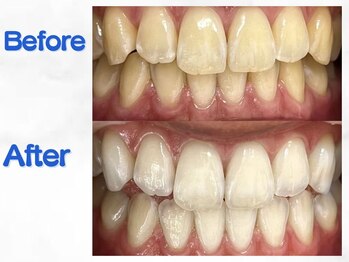 LBSホワイトニング 梅田店/ホワイトニングビフォーアフター