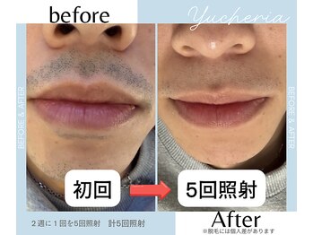 ユシェリア(Yucheria)/yucheria ヒゲ脱毛経過