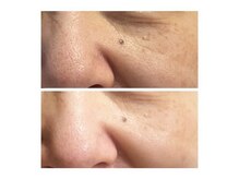 レコンテ 大通店(RECONTE)/コラーゲンケア