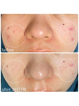 ちらちゅら/乳酸菌＋ハーブピーリング