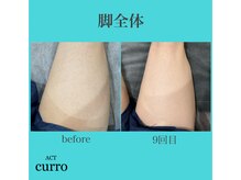 アクト クロ(ACT curro)/【脚全体】脱毛施術例