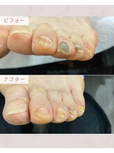 ふっとけ庵/肥厚爪ケア