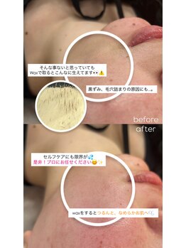 ミモザ(MIMOZA)/【フェイシャルwax光脱毛】