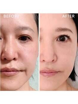 水光ピールスキン/ホームケアで改善報告頂きました