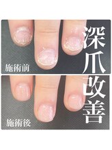 バーロ ビューティールーム(Balo Beauty Room)/深爪改善　三軒茶屋