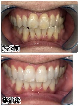ホワイトニングビューティー 名古屋栄店(WHITENING BEAUTY)/セルフホワイトニング