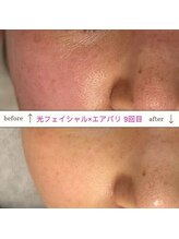 キュオバイアンドリープ(Qo by &LEAP)/光フェイシャル×エアバリ