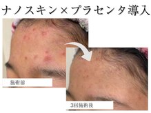 ヌナ(NOONA)/ナノスキンNN×プラセンタ