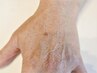 【意外に見られている★年齢が見える手の甲のシミケア】20分取り放題
