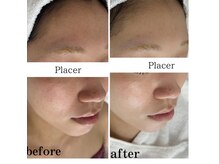 プラセル(Placer)の雰囲気（高濃度ビタミンケアで毛穴ケアはもちろん美白ケアも叶っちゃう♪）