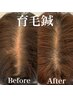 【育毛促進・抜け毛対策】育毛鍼で頭皮活性×血流促進 ￥15000→￥2980