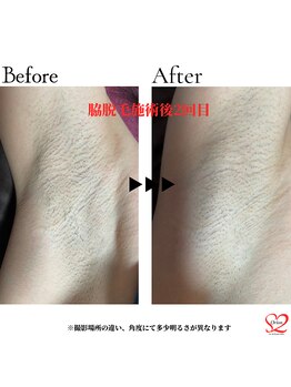 オリオンドットエスツー(Orion.S2)/【Before→After】