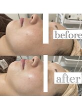 カラン(Calin)/つやつやフェイスラインすっきり