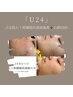 【学割U24】肌荒れニキビケアに♪ぷる肌最強美肌へ◎4500円