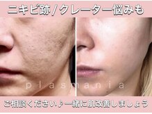 クレバイエヌアイビュティー(cle' by N eye beauty)の雰囲気（【深いお悩みもお任せください】プラズマ×ハーブ施術が大人気♪）