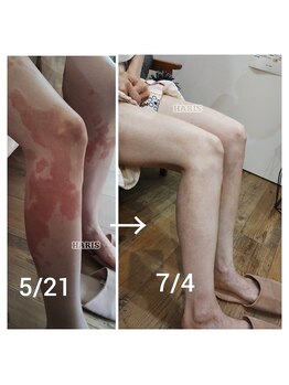 ハリス(HARIS)/強度の赤み・痒み減少　95％治癒