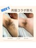 【メンズ】脇毛はムレやニオイの原因★WAX＆光脱毛で清潔感UP★脇脱毛 ¥5500
