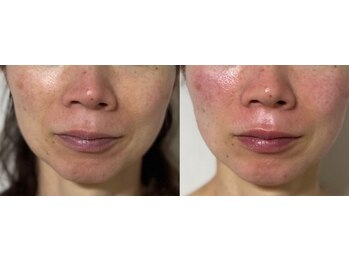 ヒトヤスミ(Hitoyasumi)/小顔効果抜群