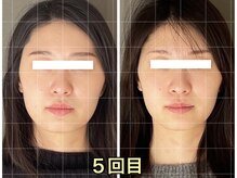 ソルビーフェイス(SOL*BeFace)/小顔矯正30分×5回でこの変化☆
