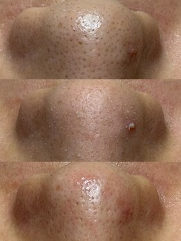 フェリシダージ(felicidade)の写真/その毛穴悩み、諦める前に。丁寧なカウンセリングと本格ケアで思わず触れたくなるような、なめらかな肌質へ