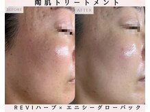 ルリエベル(Relier Belle)/REVIハーブ×炭酸ガスパック