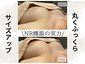 ボニービューティー(Bony Beauty)/BeforeAfter【3】