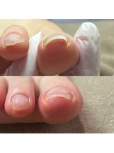 セラキュアネイル(Theracure nail)/3回の施術で巻き爪補正卒業