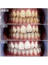 ハピネス 心斎橋アメリカ村本店(Happiness)/1番人気