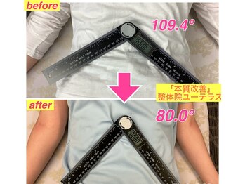 ユーテラス/産後ケアで肋骨の開きが改善！