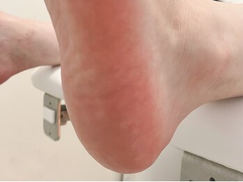 クオーレ(Cuore)の写真/【足裏角質ケア】タコ・魚の目・かかとの乾燥・ひび割れ・亀裂にお悩みの方に◎自慢できる素足へ☆