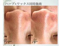 ポノ 茅ヶ崎(Pono.)/湘南/毛穴/ハーブピーリング