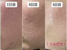 ビシェルジュ(SHALUGE)の雰囲気（最短5日でツヤ肌。ハーバルシー！角質ケアでホームケアの効果◎）