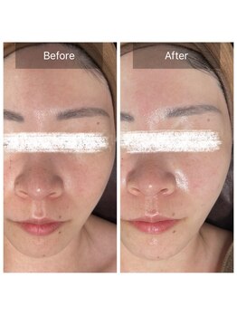 ラビ(RABBI)/30代女性小顔矯正