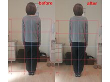 ゆずのき/猫背/巻き肩調整 before after