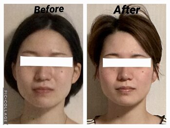 ショウフェイスデザイン(Sho Face Design)/《小顔矯正》ビフォーアフター