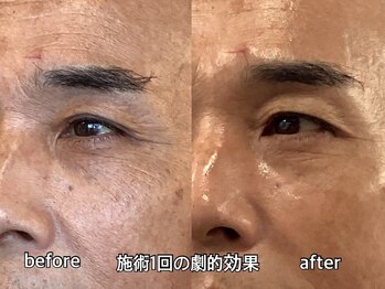 リエル(RIEL)/【眉脱毛】