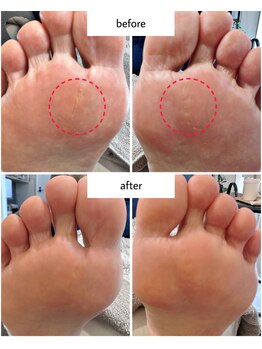 ケアプラス(care plus)/足裏角質ケア