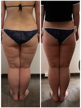 ビューティールーム 優美/セルライトケア　継続中