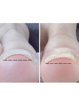 爪の悩みを解消できる（ケア含む）