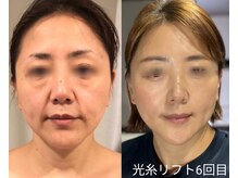 エム(M)/光糸リフト