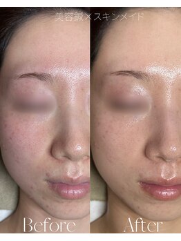 ルミア(LUMiA)/毛穴・赤み・くすみ改善♪