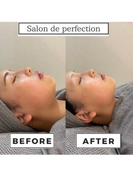サロン ド パーフェクション(Salon de Perfection)/小顔リフト