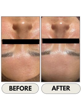 リーリア(LiLia)/ハーブピーリングBefore・After