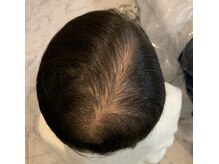 アブソリュートワン(absolute1)/頭髪育毛促進☆エクソソーム