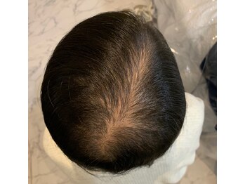 アブソリュートワン(absolute1)/頭髪育毛促進☆エクソソーム