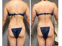 フュース(Futh)/１回施術☆腰回りクビレ